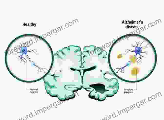 Alzheimer's Disease Brain Alzheimer S Disease (Topics In Medicinal Chemistry 2)